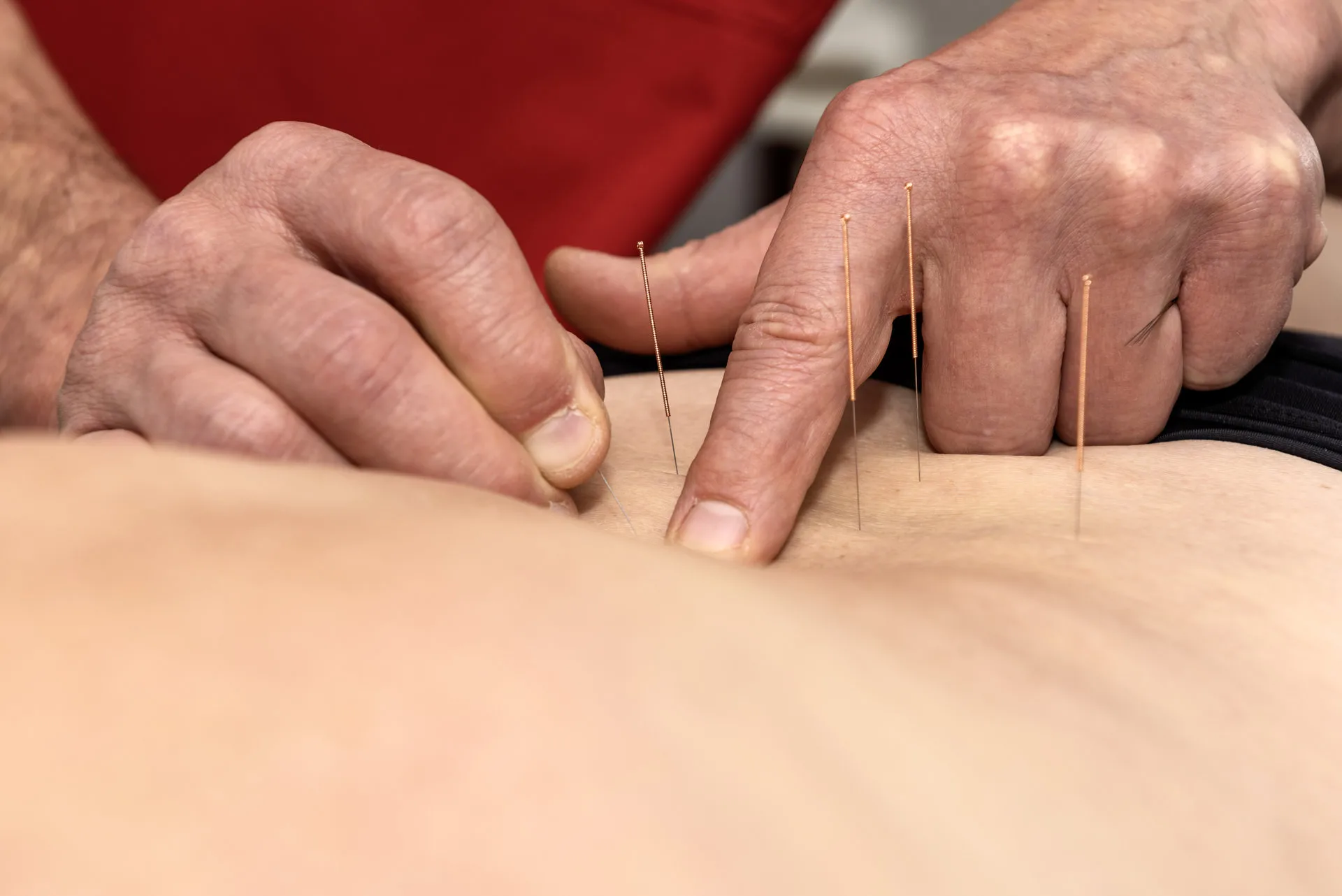 L’acupuncture